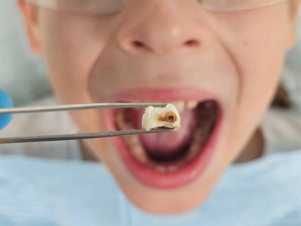 Best Emergency Dental Care for Broken or Chipped Teeth in Eaton, IN